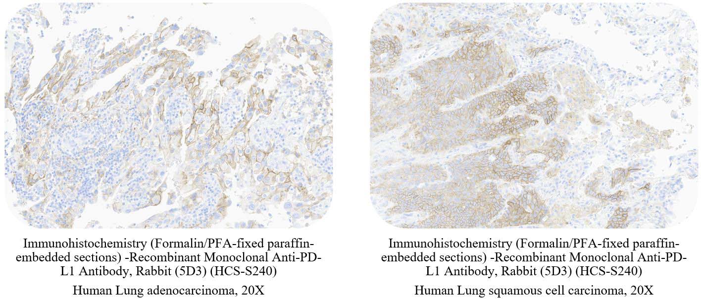  PD-L1 CANCER SAMPLE