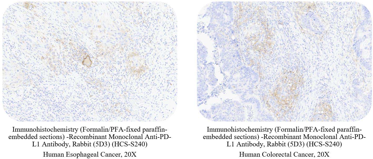  PD-L1 CANCER SAMPLE