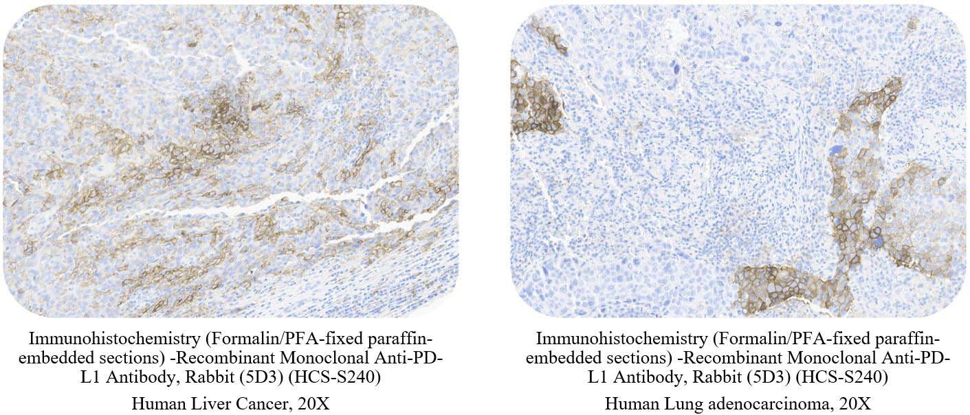  PD-L1 CANCER SAMPLE