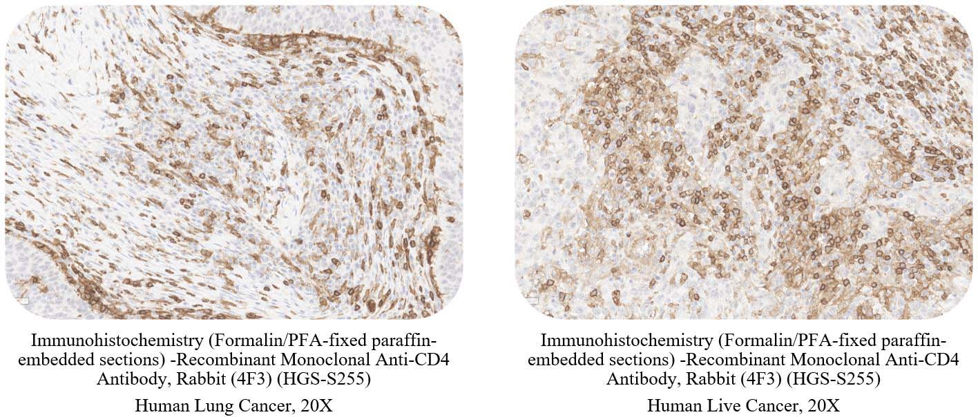  CD4 CANCER SAMPLE